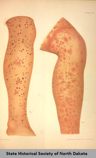 Limbs showing effects of scurvy.